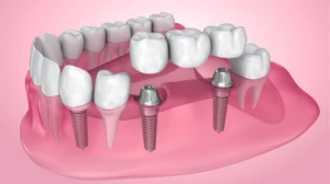 Why Are Dental Implants So Expensive in Australia?