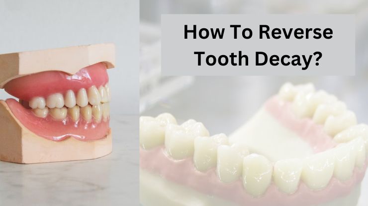 How To Reverse Tooth Decay